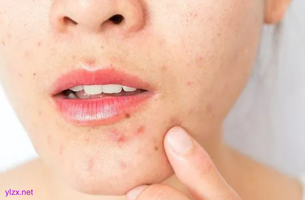 这种“红包”又痛又肿 硬挤真的很危险 这种“红包”又痛又肿 硬挤真的很危险