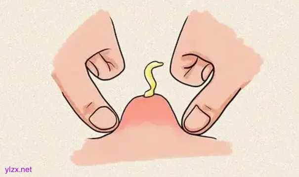 这种“红包”又痛又肿 硬挤真的很危险 这种“红包”又痛又肿 硬挤真的很危险