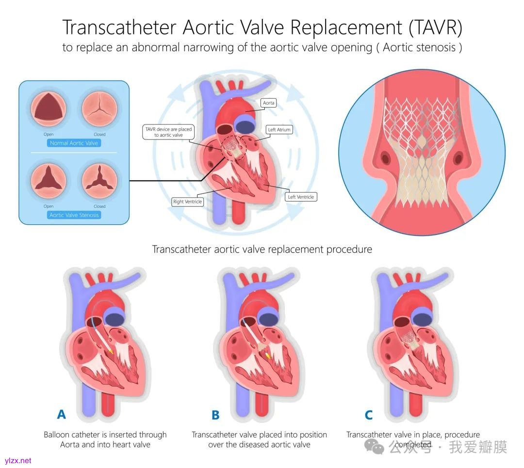 Transcatheter Aortic Valve Replacement (TAVR) Procedure Salinas, CA