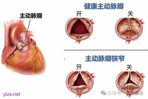 【曙光·动态】我成功实施一例经导管主动脉瓣置换术（TAVR）_澎湃号·政务_澎湃新闻-The Paper