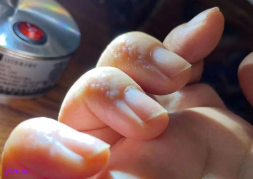 手上这种小水泡千万别挠破 多数人不知道的汗疱疹误区 手上这种小水泡千万别挠破 多数人不知道的汗疱疹误区