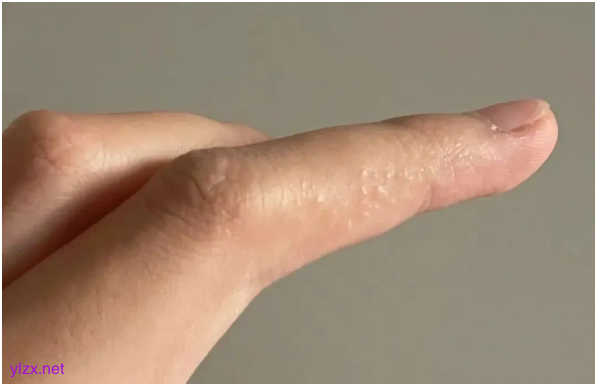 手上这种小水泡千万别挠破 多数人不知道的汗疱疹误区 手上这种小水泡千万别挠破 多数人不知道的汗疱疹误区