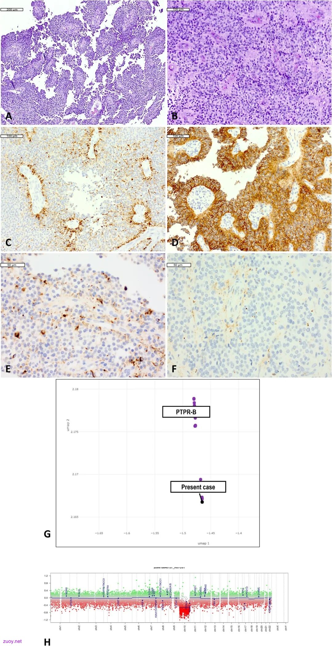 Figure 2 组织学、免疫组织化学和分子特征