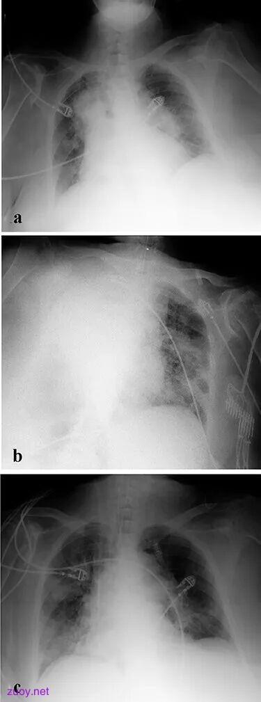 fig3-literature-endobronchial-intubation